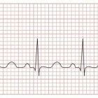 Van elektrocardiogram (ecg) tot hartkatheterisatie